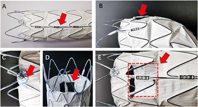 Self-Radiopaque Markers Guiding Physician-Modified Fenestration (S-Fenestration) in Aortic Arch Endovascular Repair